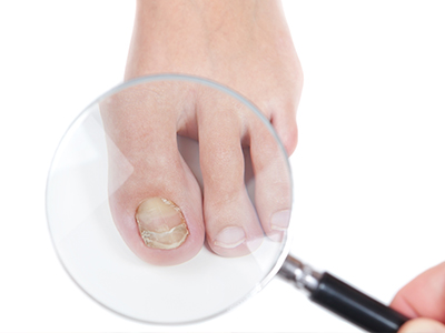How to Clear Up Fungal Toenails Fast: Advanced Foot & Ankle Center: Podiatry